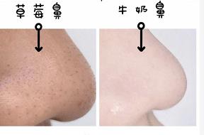 去黑头鼻贴推荐黑头导出液,去黑头的最好办法告别草莓鼻