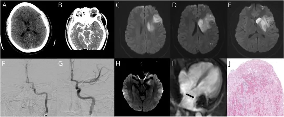 房颤脑梗塞取栓术后抗凝时机,左心房黏液瘤与血栓鉴别