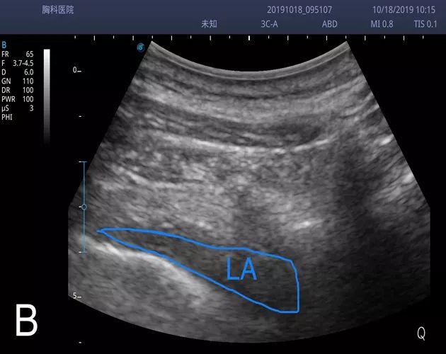胸椎旁神经阻滞时需要穿过的韧带,胸椎旁神经阻滞超声探头位置