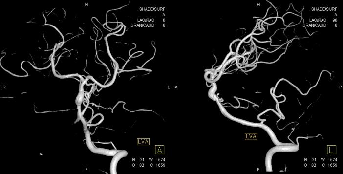穆如清风·第13期｜Tubridge治疗基底动脉巨大夹层动脉瘤