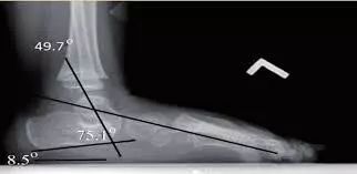 鸭脚板和扁平足的区别,鸭脚板是不是扁平足