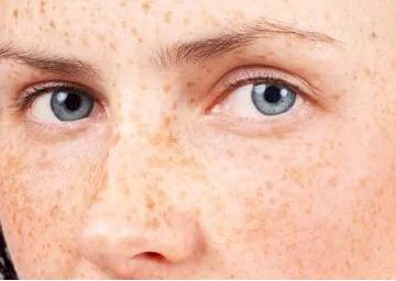 祛斑最有效是仪器还是产品,公认的祛斑第一名食物