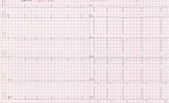 专栏丨贾卫滨：心电图“掉头”现象的定义与诊断特征（1）