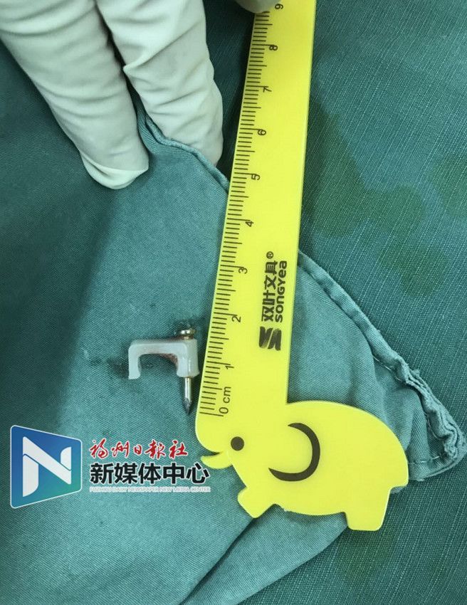 2岁孩子误吞2厘米钉子,4岁小孩误吞钉子