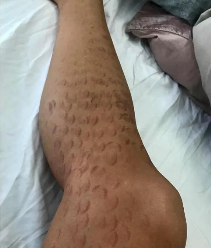 女子激光脱毛腿部长满红疹,女子脱毛手术后20天死亡