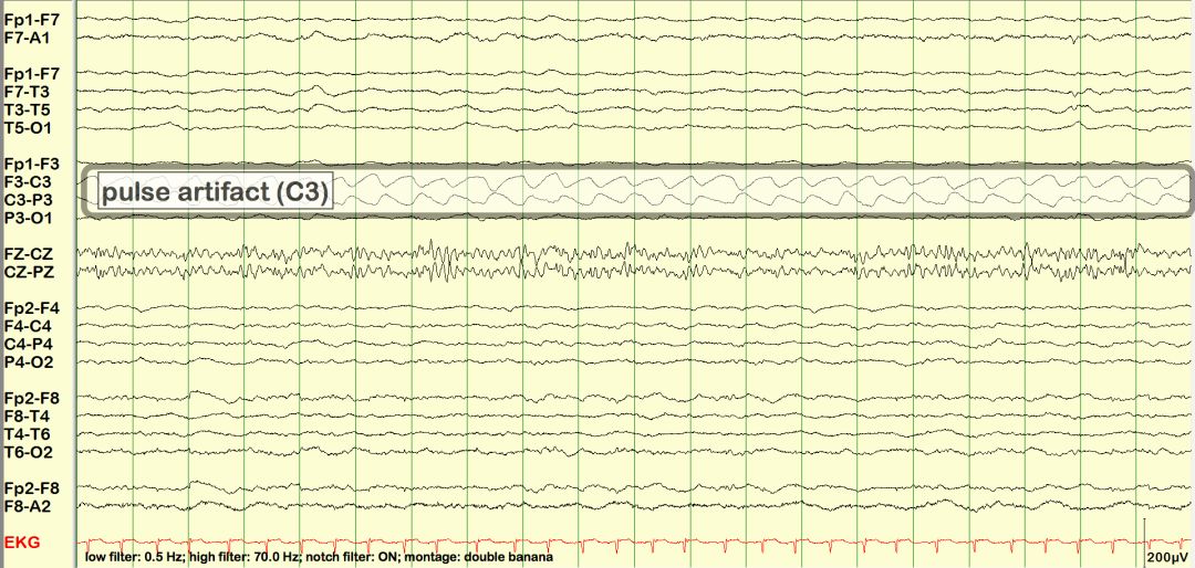 脑电图伪差图,脑电图伪差图谱