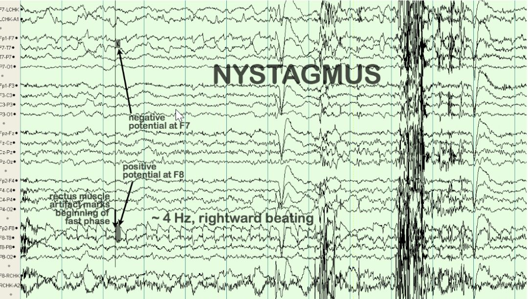 脑电图伪差图,脑电图伪差图谱