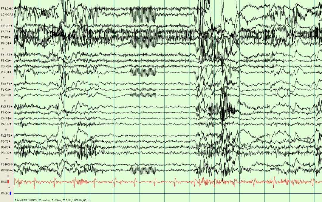 脑电图伪差图,脑电图伪差图谱