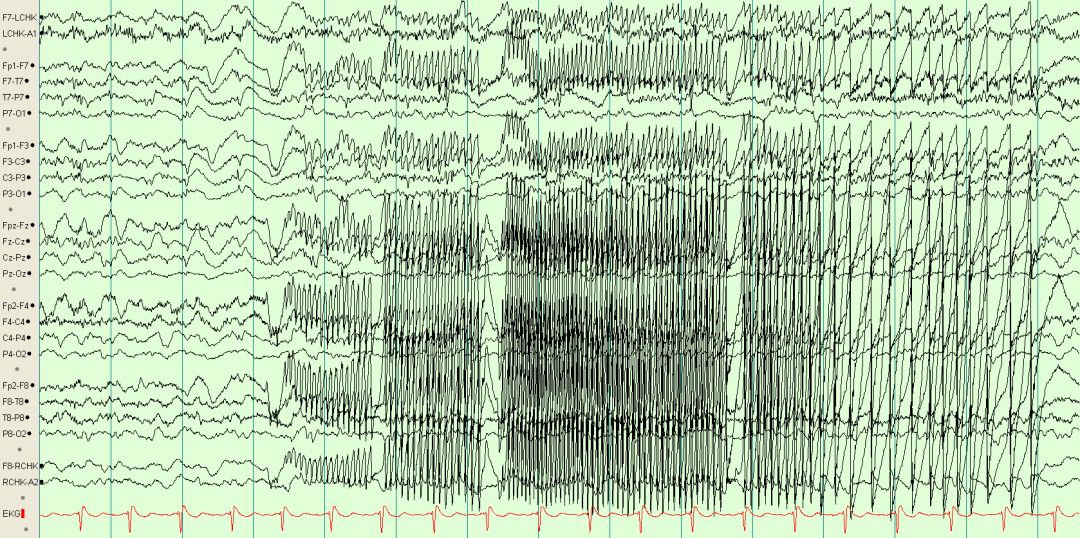 脑电图伪差图,脑电图伪差图谱