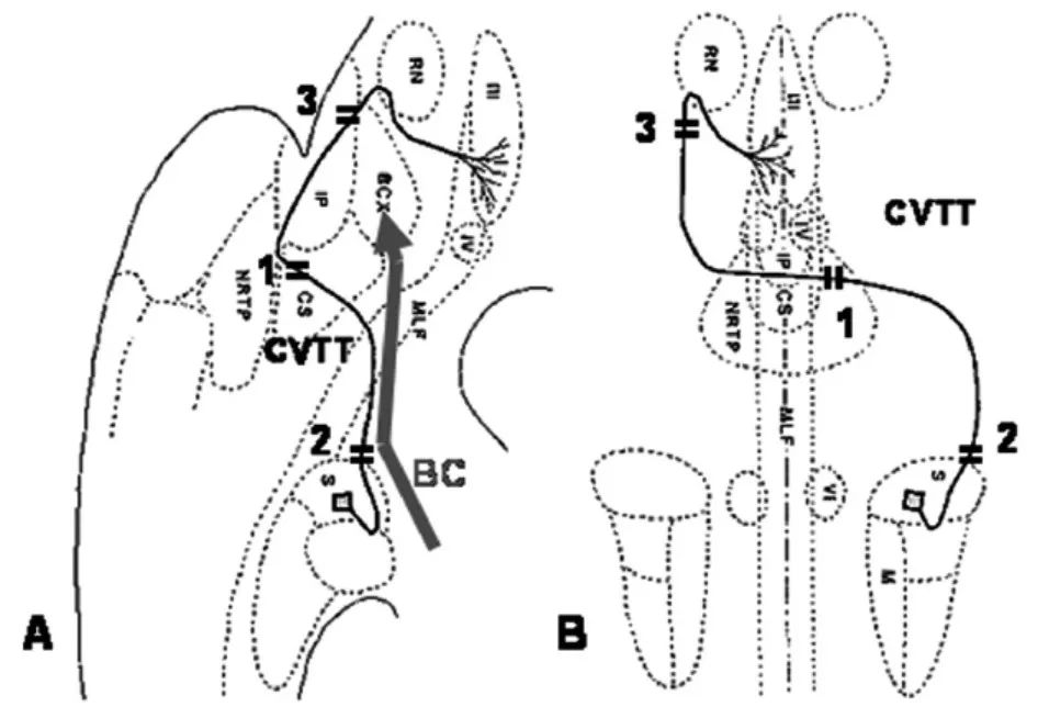 耳石症眩晕手法视频,耳石症头晕怎么训练