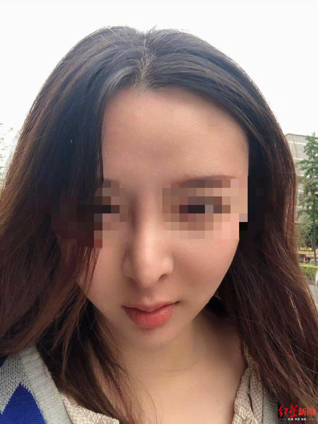 医美整形鼻子歪了只能自认倒霉吗,年轻女子整容后结果嘴巴整歪了
