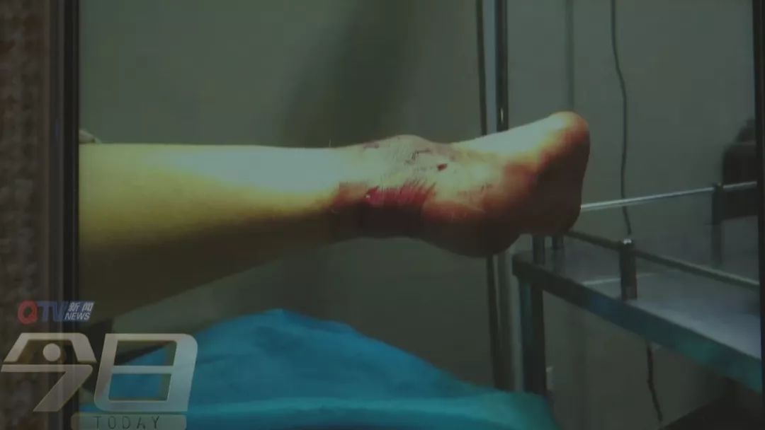 女子头部被瓷砖砸伤,女子被高空掉落瓷砖砸伤