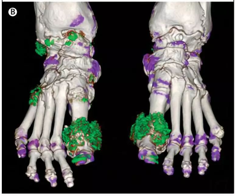 秋水仙碱真的很可怕吗,秋水仙碱已经禁用了吗
