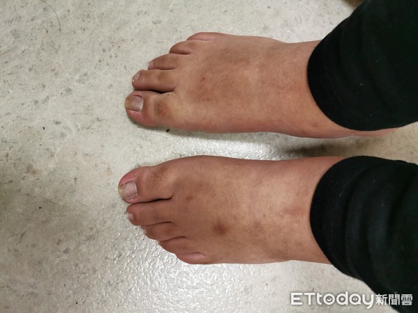 生日变调！27岁女连吃5天火锅脚趾爆肿，痛到失眠　医：这汤别喝