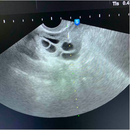 取卵后多久出院,取卵手术有多疼