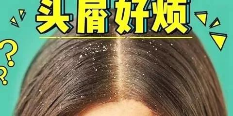 冬天头皮特别痒还有头皮屑,冬天洗头有头屑怎么办
