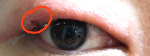 肖战麦粒肿上热搜！什么，眼皮红肿热痛就是麦粒肿？麦粒肿：这个锅我不背