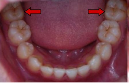 关爱口腔预防龋齿,爱牙科普小实验