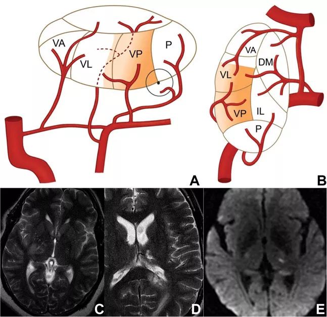 脑梗死的分类及ct影像学表现,丘脑梗死的临床表现