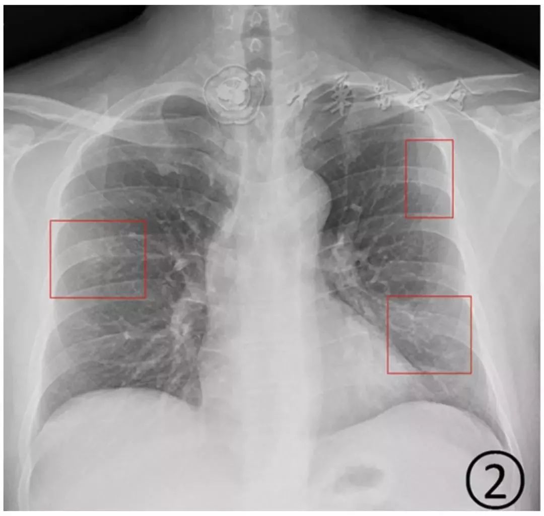新冠肺炎影像演变过程,新冠肺炎胸部影像学特点有哪些