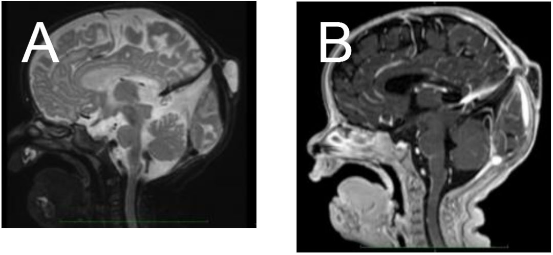 小孩后脑勺枕骨一侧有凸起骨头,七岁的小孩后脑勺一侧有凸起骨头