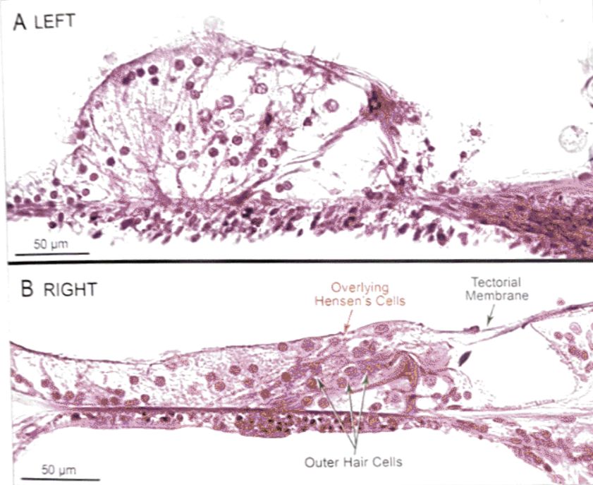梅尼埃病深度解析,梅尼埃病病理解剖