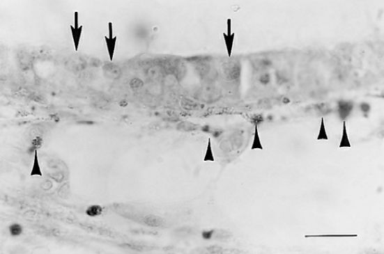 梅尼埃病深度解析,梅尼埃病病理解剖