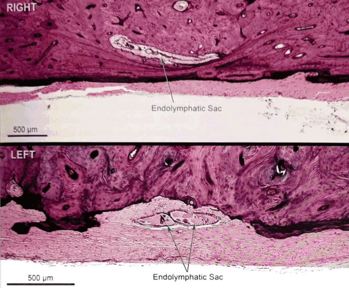 22张图，细说梅尼埃病的组织病理学特点丨“晕”筹帷幄