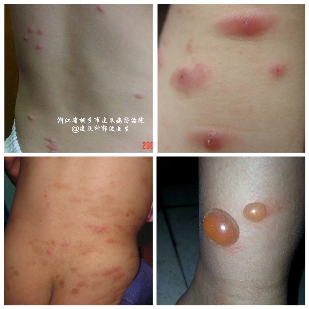 丘疹性荨麻疹最佳治疗方法,丘疹性荨麻疹防治措施