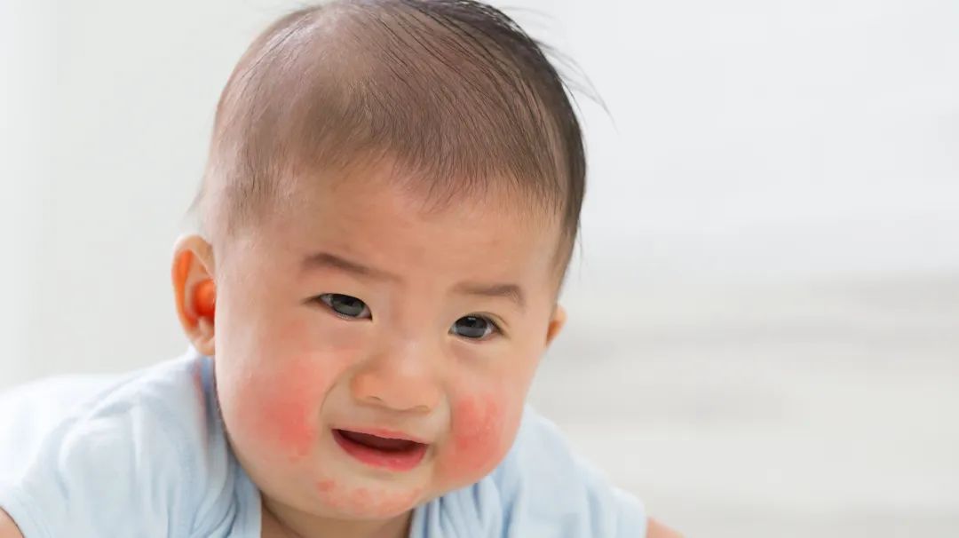 宝宝湿疹反复发作怎么断根,湿疹反复发作会引起癌变吗