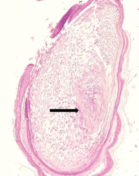六个月宝宝粟丘疹,婴儿长粟丘疹是因为母乳吗