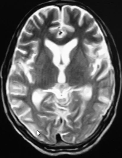 低血糖频发的症状及原因,反复低血糖病例