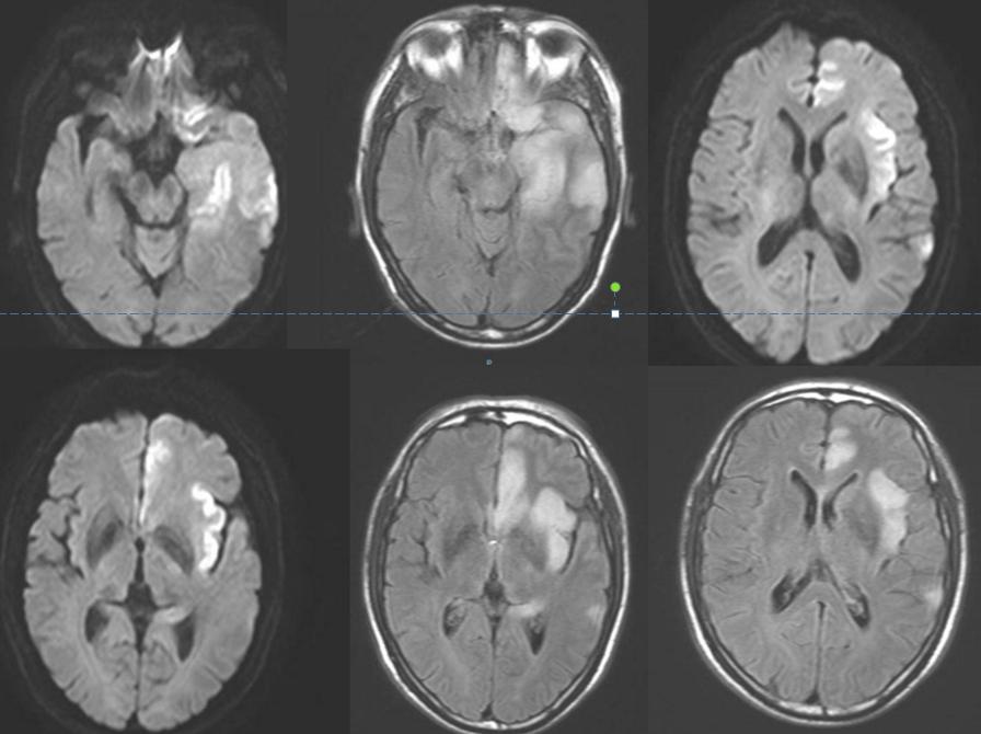 枫糖尿病、血管型梅毒、Hopkins综合征、Susac综合征丨3分钟读片·2期