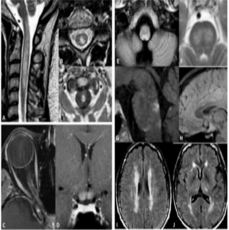 张星虎视神经脊髓炎,张星虎多发性硬化