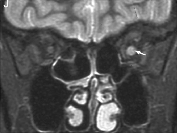 张星虎视神经脊髓炎,张星虎多发性硬化
