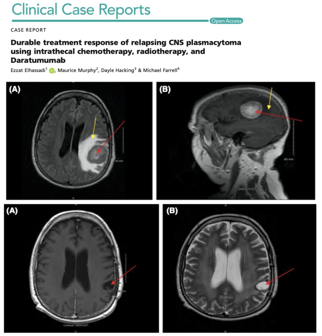 多发性骨髓瘤三期的治疗方案,复发多发性骨髓瘤指南