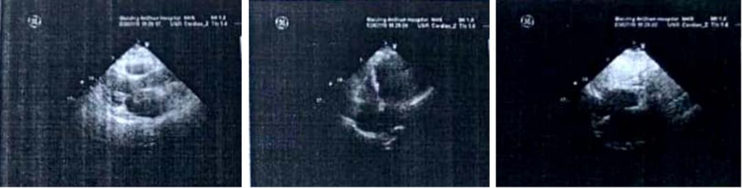 琥珀酸美托洛尔治疗房颤的研究,琥珀酸美托洛尔缓释片治早搏用量