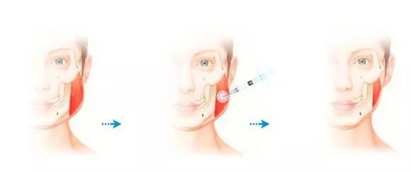 脸大有什么方法简便而快速的瘦脸,脸大瘦脸方法有用吗