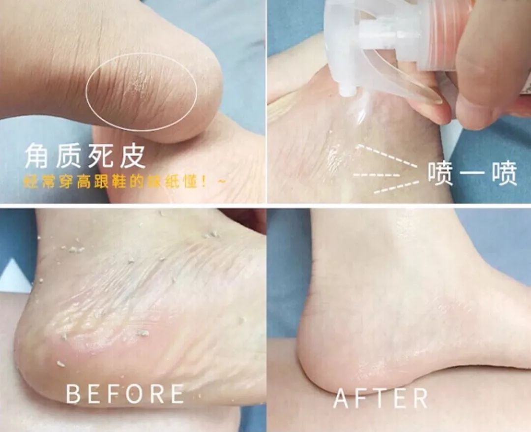美脚神器哪个效果最好,美脚神器去角质呵护足底