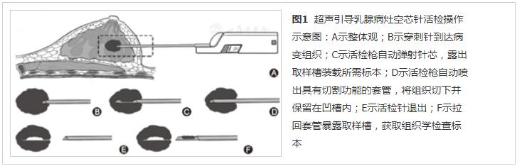 超声引导下乳腺穿刺活检的适应症,乳腺前哨淋巴结活检术