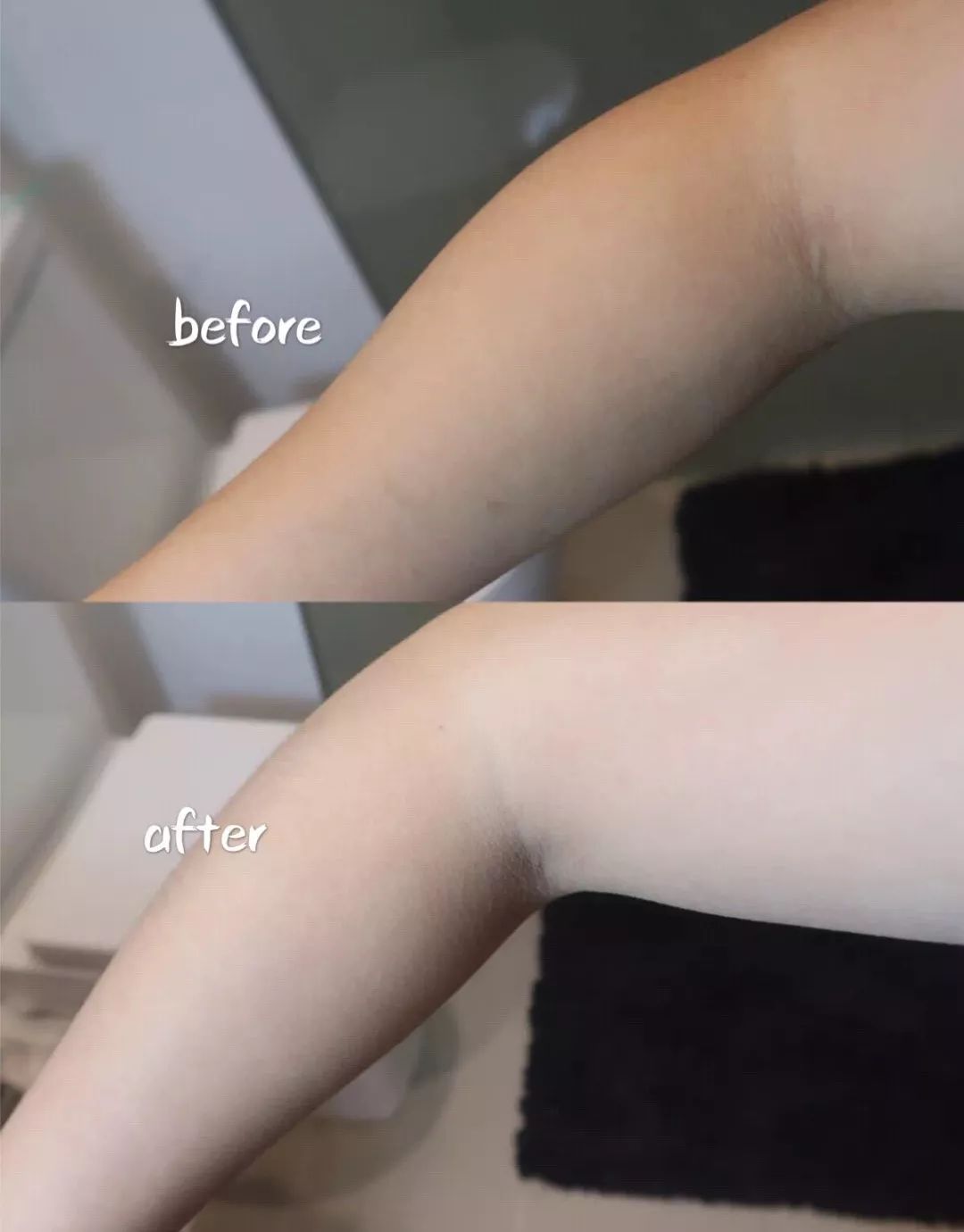 前胸鸡皮痘痘怎么处理,胸背痘痘清理