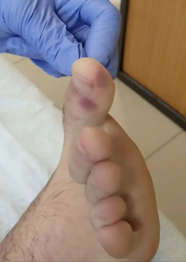 新冠感染脚上起痘痘,新冠病毒脚上会起疹子吗