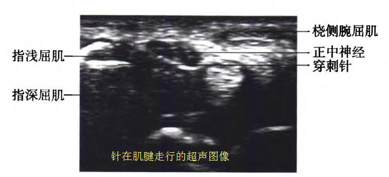 腕管综合征超声介入治疗,超声引导下腕管综合征注射治疗