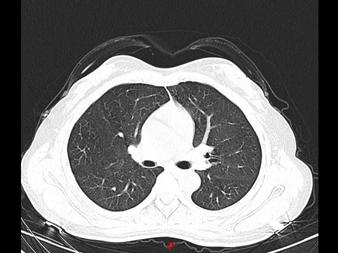 误用84消毒液,84消毒液使用错误事故