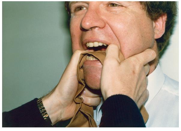 哪几处骨折最轻,头部骨折分为几种类型