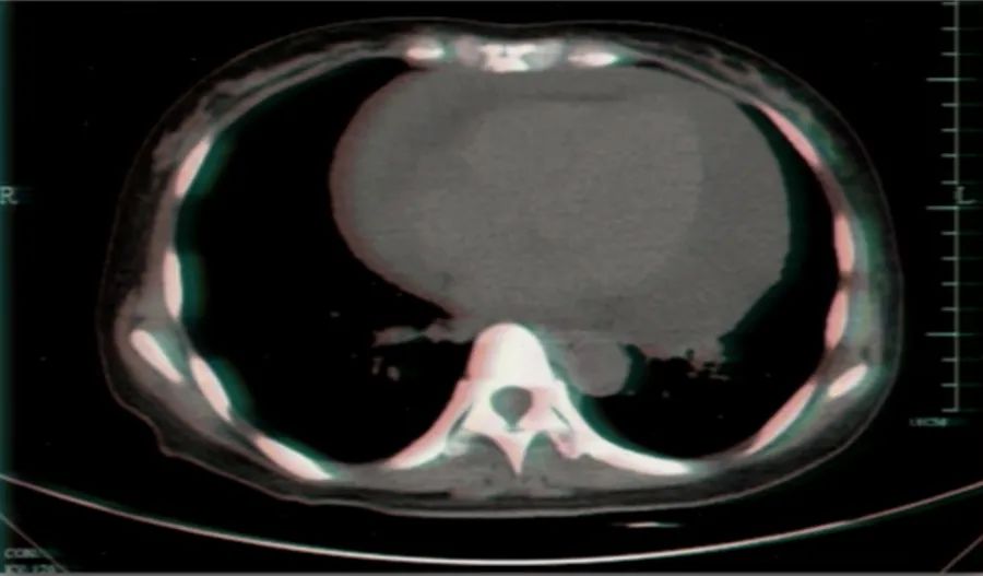 恶性心包积液怎么引起的呀,不明原因反复大量心包积液怎么办