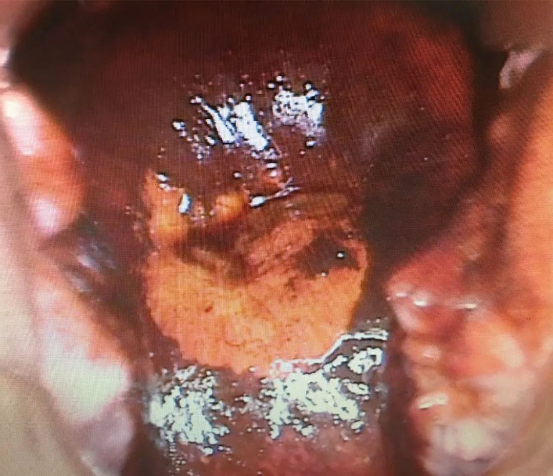 处女膜仍在的17岁孕妇，罕见双宫颈的35岁女人……那些不想用手术刀的妇科术者