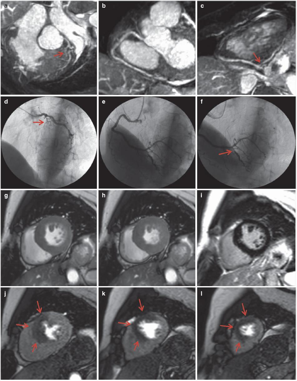 怎么看懂ct冠状动脉造影图片,冠状动脉造影图讲解