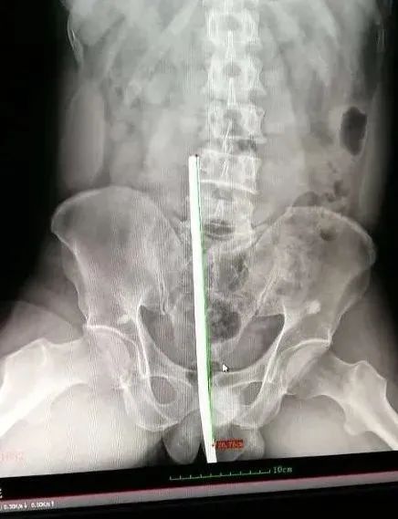 男子35厘米钢筋直穿腹部内脏！惠东医生上演生死时速