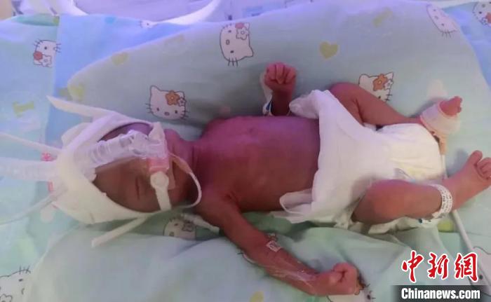 二斤重早产女婴,出生仅1斤多的早产宝宝顺利出院